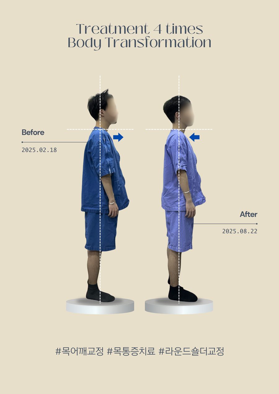 목어깨교정 라운드숄더 전후사진