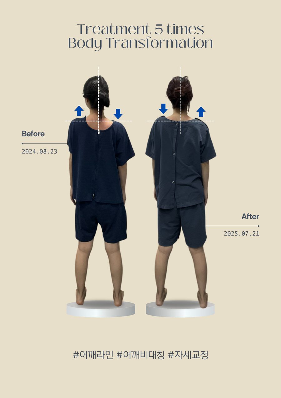 어깨비대칭 교정 전후사진