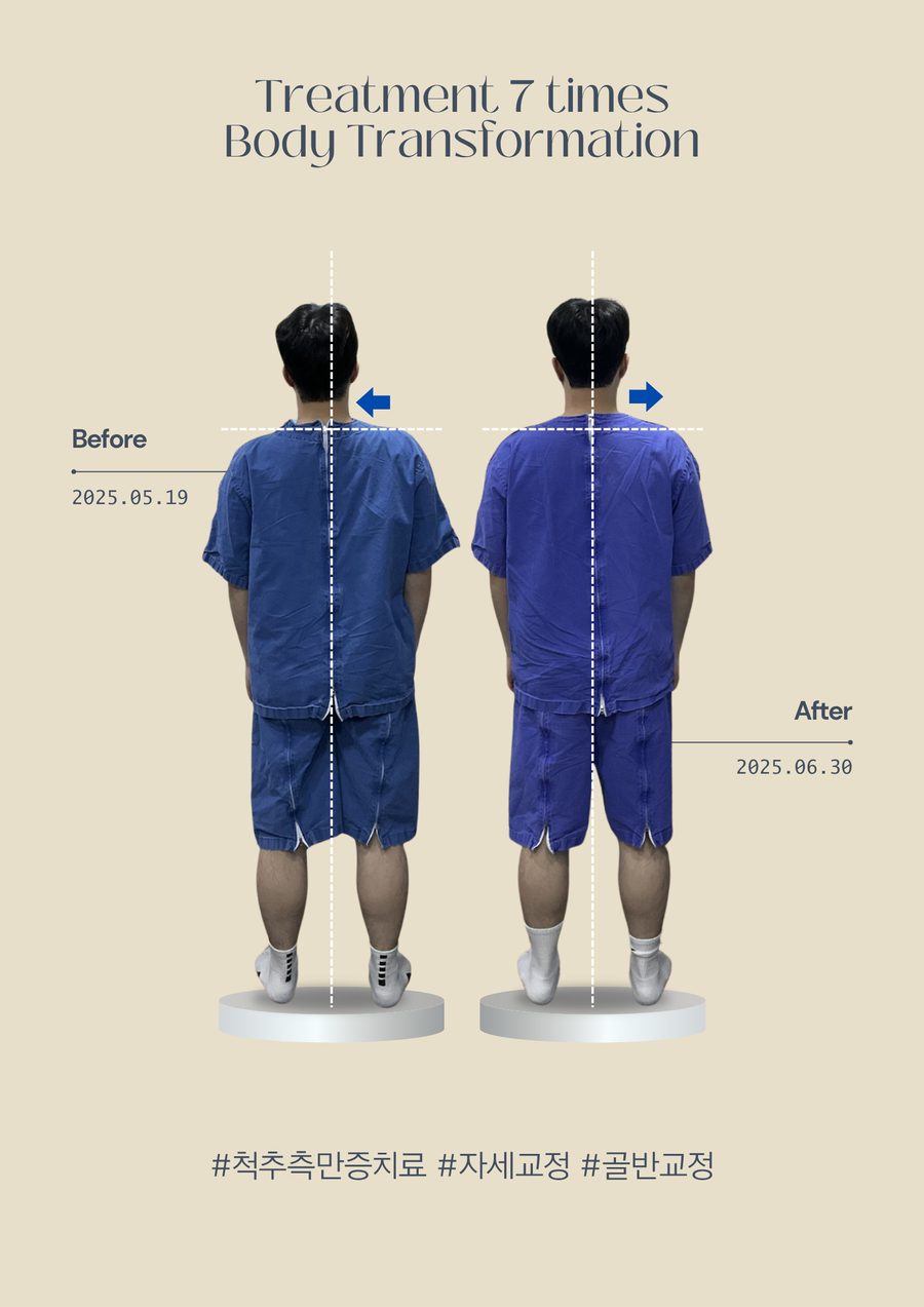 척추측만증 자세교정 전후사진
